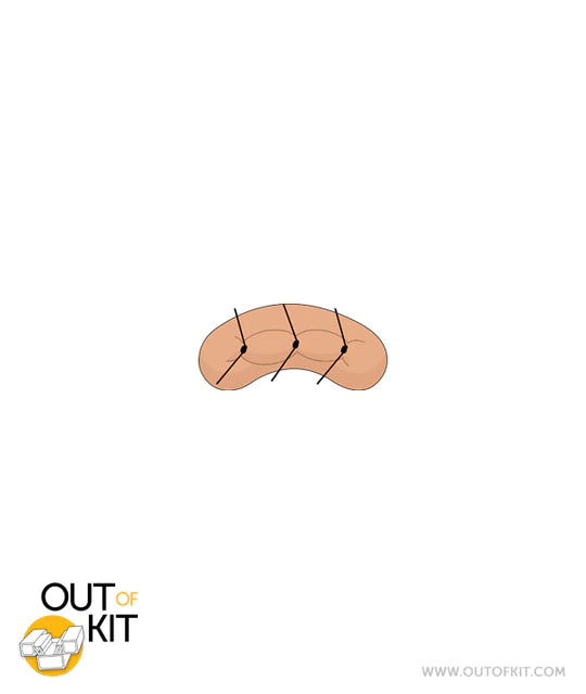 Out of Kit Micro Suture 3 Stitch