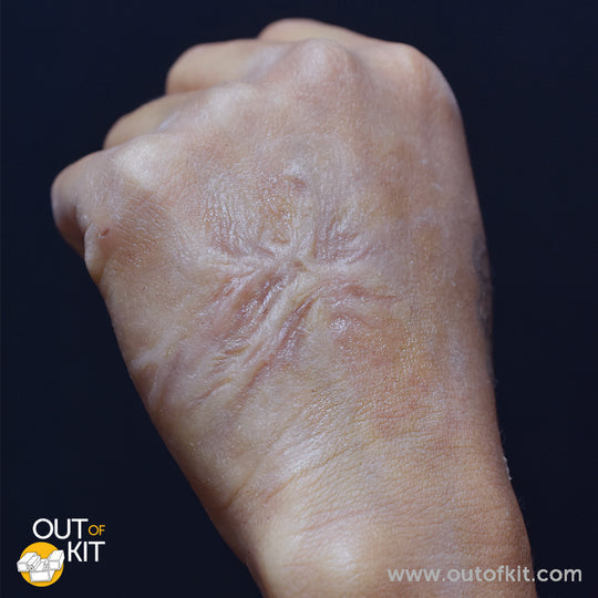 Out of Kit Healed Burn Scar 2