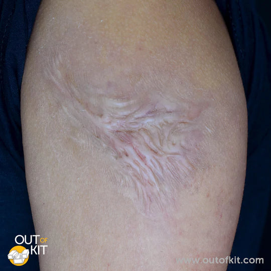 Out of Kit Healed Burn Scar 5