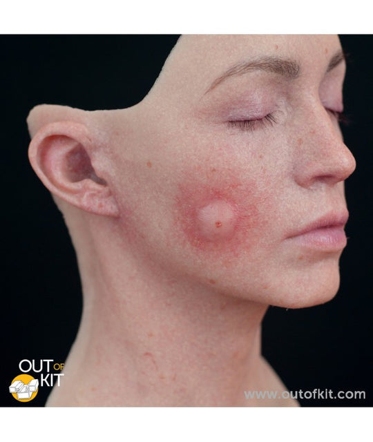 Out of Kit Insect Bite (XL)