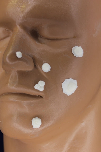 Warts Moles and Pimples Insert
