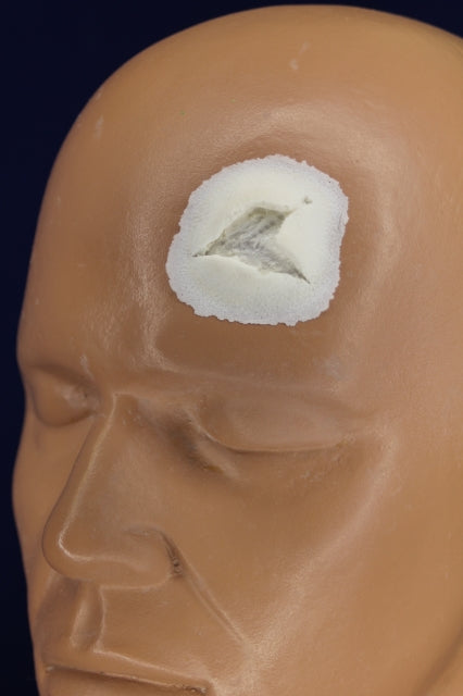 Triangle Wound Insert
