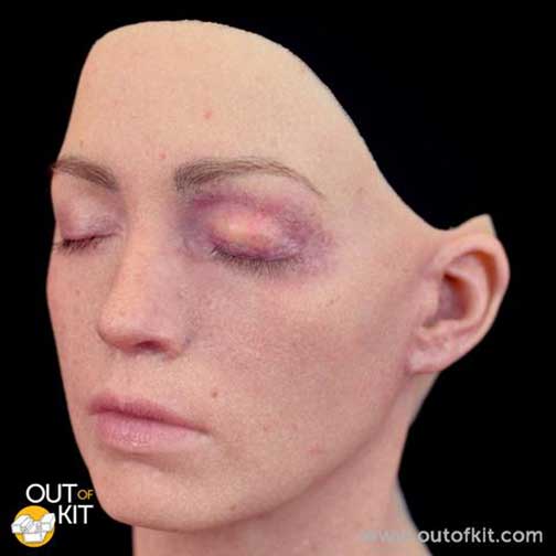 Out of Kit Swollen Upper Eyelid 2 Applied