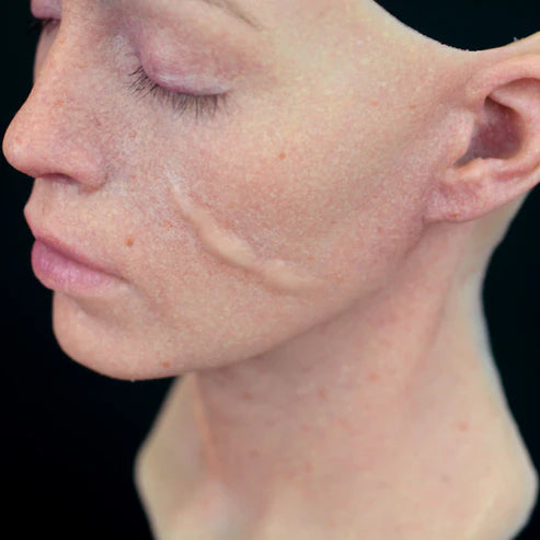Out of Kit Curved Keloid Scar 6