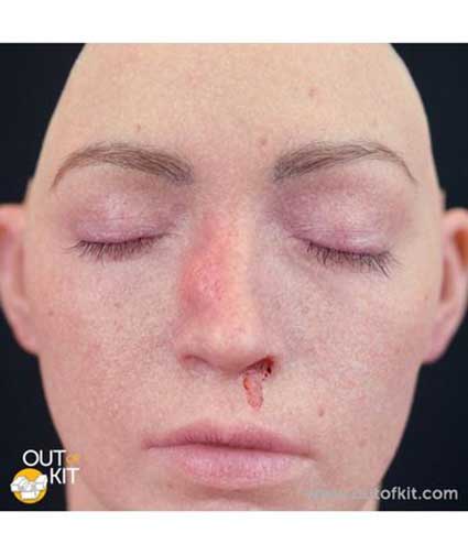 Out of Kit Broken Nose Applied