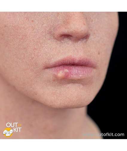 Out of Kit Cold Sore 3 Applied