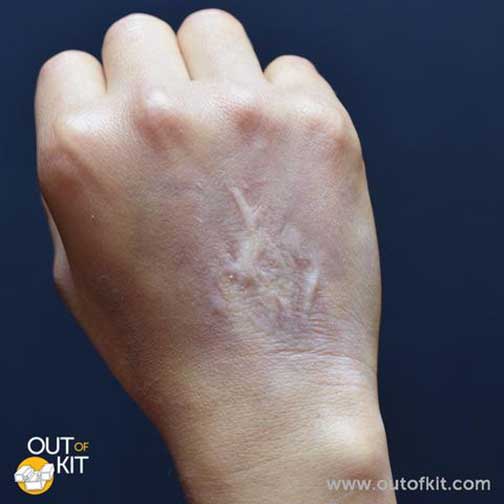 Out Of Kit Healed Burn Scar 1 Applied